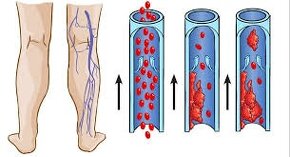 Predám MAGNETOTERAPIA KRUH BIOTORUS LT 100 - 17