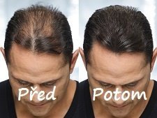 TOPPIK zahusťovacie vlákna- riedke vlasy/alopécia - 2
