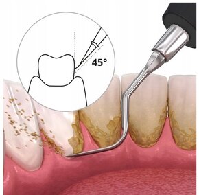 Sonický odstraňovač zubného kameňa - skvelý darček - 3