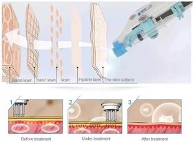 Nový Hydro injector mezoterapia vital rejuvenizacia - 6